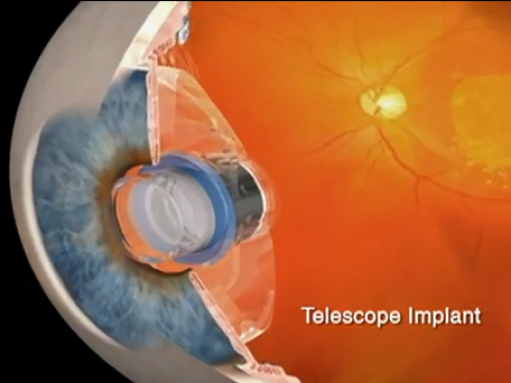 Een telescoop in je oog