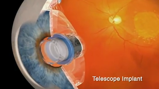Een telescoop in je oog
