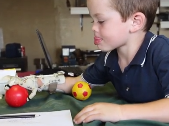 3D geprinte handprothese